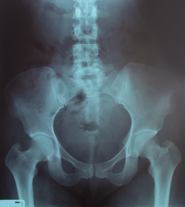 盆腔X光片图片