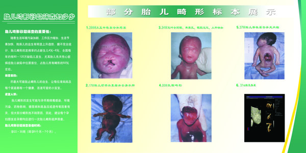 胎兒彩超篩查部分胎兒畸形標本展示