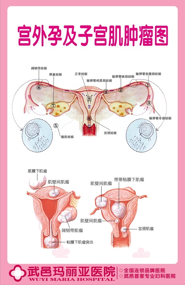 宫外孕及子宫肌肿瘤图图片