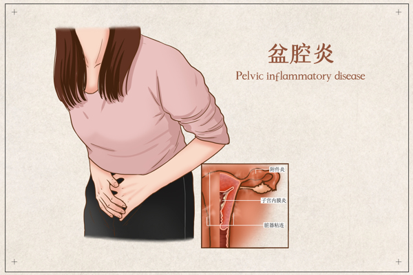 盆腔炎疾病健康卫生背景素材图片
