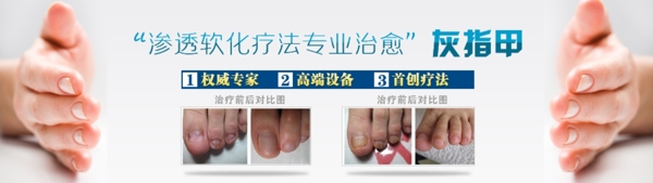 灰指甲治疗技术图片